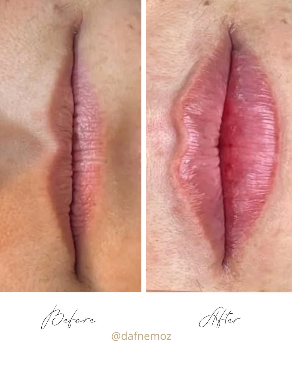 Relleno de Labios